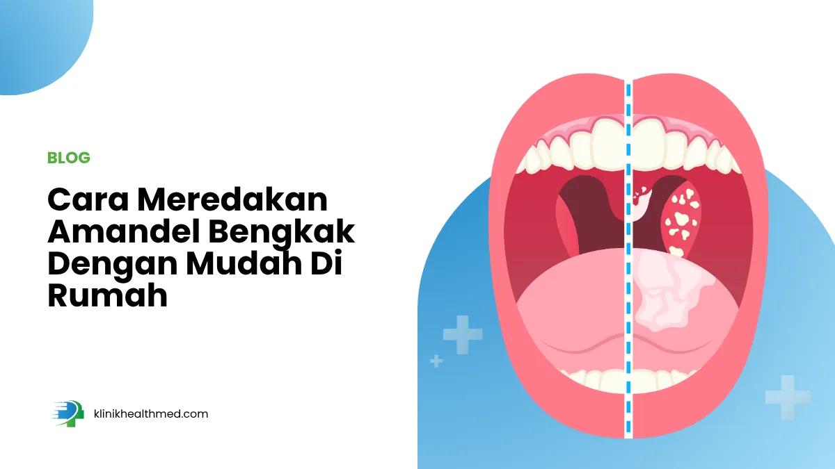 Cara Meredakan Amandel Bengkak